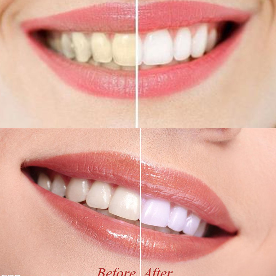 대나무 숯 치아 치아 Dentis Lab 구강 위생 관 - Teeth Whitening Ulta 리뷰 및 가격