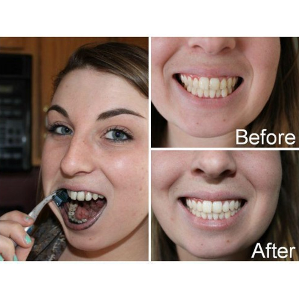 대나무 숯 치아 치아 Dentis Lab 구강 위생 관 - Teeth Whitening Ulta 리뷰 및 가격