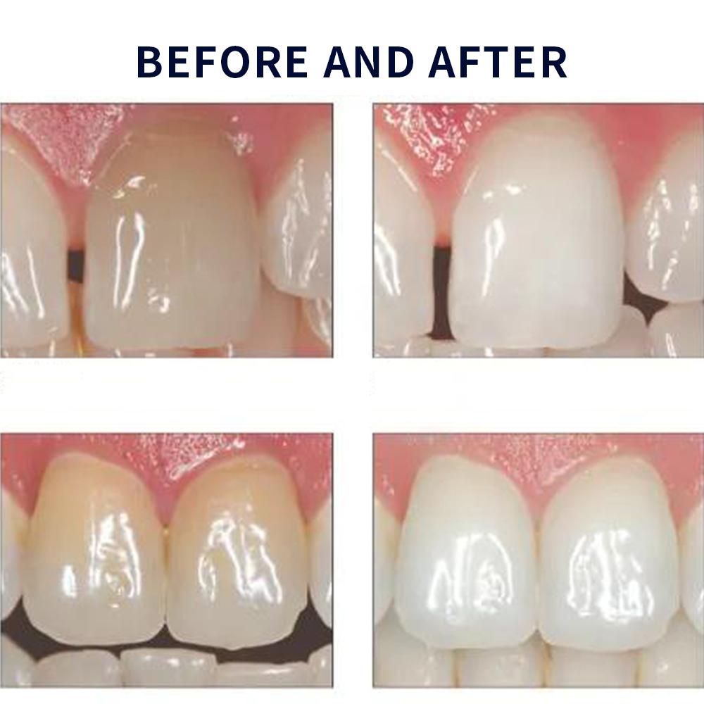 유백광 미백 20% PF 20 16 젤 키트, 초강력  - Teeth Whitening At Home Kit 리뷰 및 가격