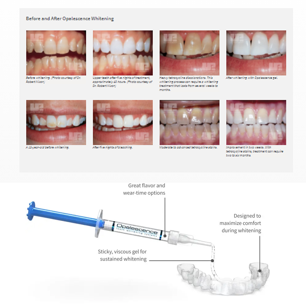 유백광 미백 20% PF 20 16 젤 키트, 초강력  - Teeth Whitening At Home Kit 리뷰 및 가격