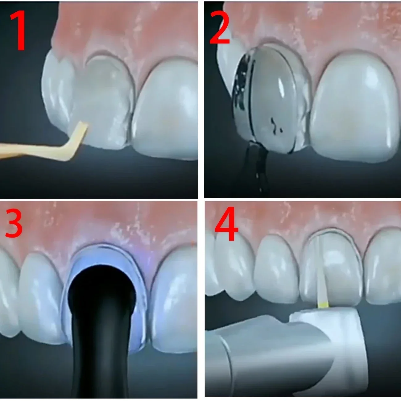 복합 레진 베니어용 치과 기공소 몰드 키트 2세트, 광 - Teeth Whitening Moulds 리뷰 및 가격
