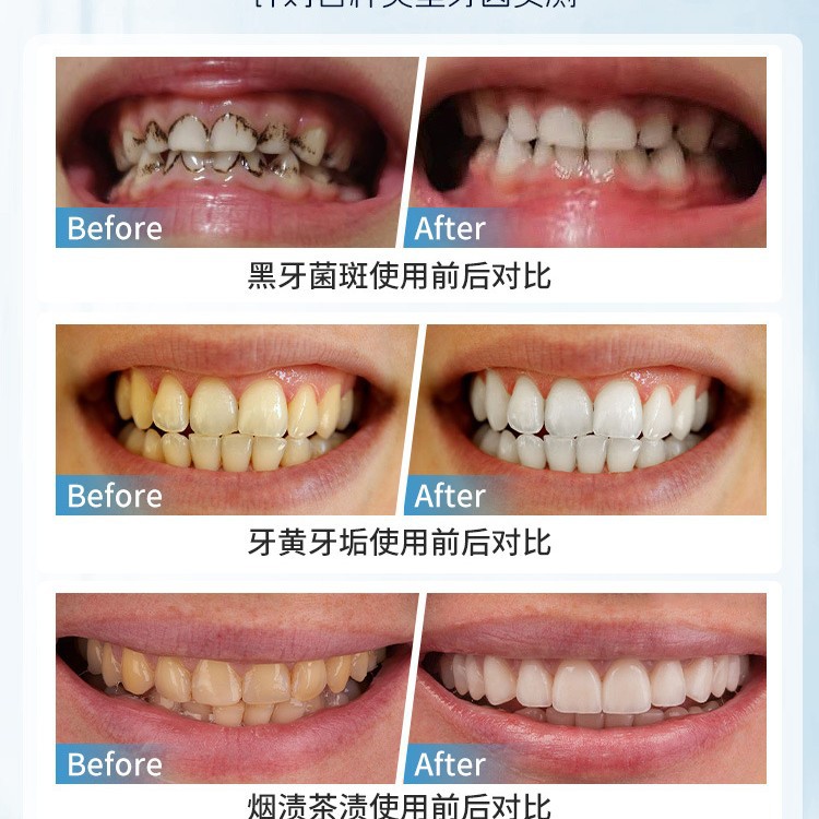 일본 수동 치아 얼룩 제거 브러시 구강 깊은 청소를위한 - Teeth Whitening In Japan 리뷰 및 가격