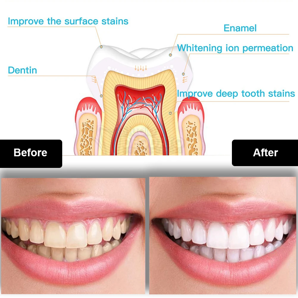 치과 치아 미백 키트 미니 16 LED 콜드 라이트 3 - Teeth Whitening Ulta 리뷰 및 가격