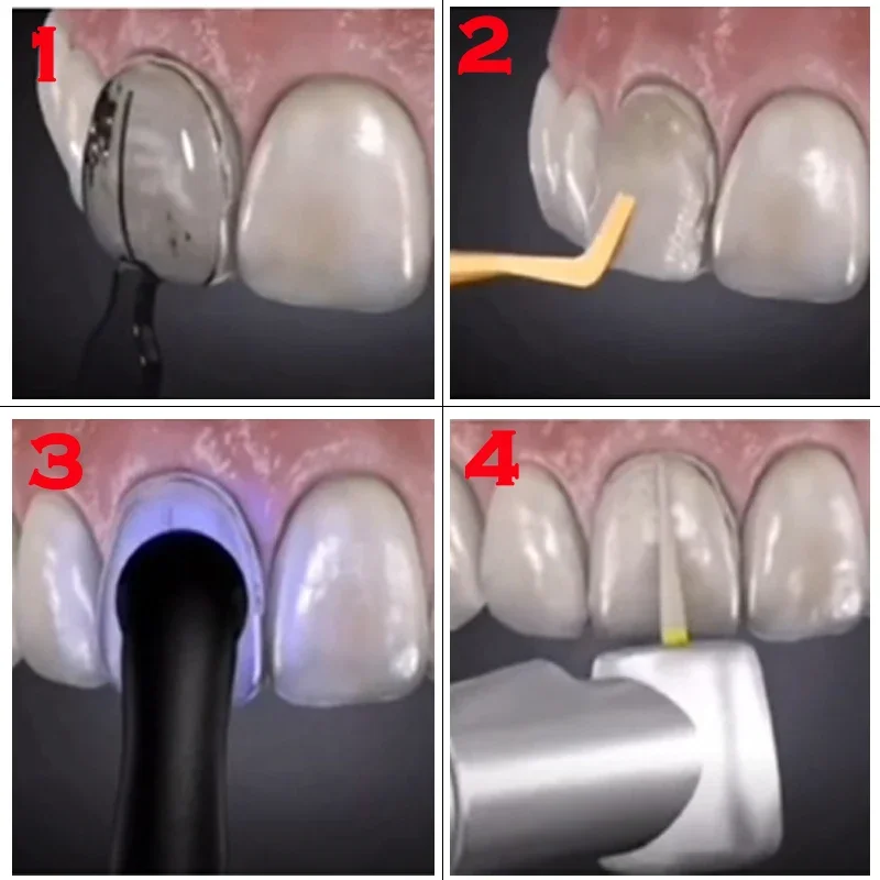 복합 레진 베니어용 치과 몰드, 광중합 충전재, 전치부 - Teeth Whitening Moulds 리뷰 및 가격