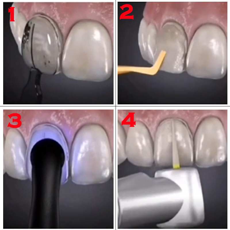 32개 치과용 베니어 몰드 키트 복합 레진 몰드 광중합 - Teeth Whitening Moulds 리뷰 및 가격