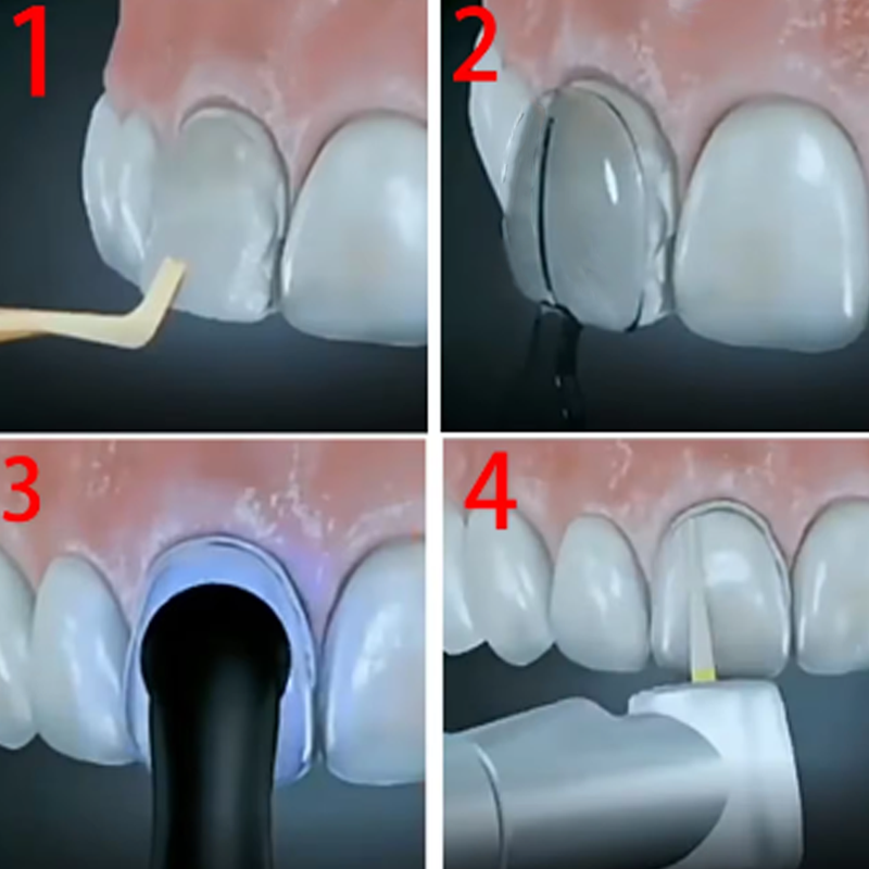 치과용 베니어 몰드 키트, 복합 송진 베니어 몰드, 광 - Teeth Whitening Moulds 리뷰 및 가격